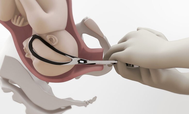 neville barnes forceps delivery