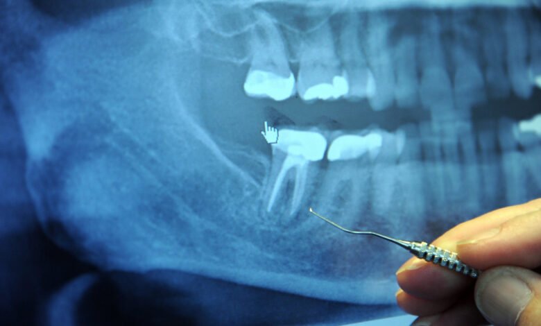 does paracetamol help toothache