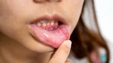 How to Get Rid of a Canker Sore in 24 Hours