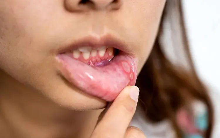 How to Get Rid of a Canker Sore in 24 Hours