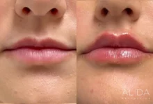 lip flip before and after