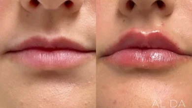 lip flip before and after