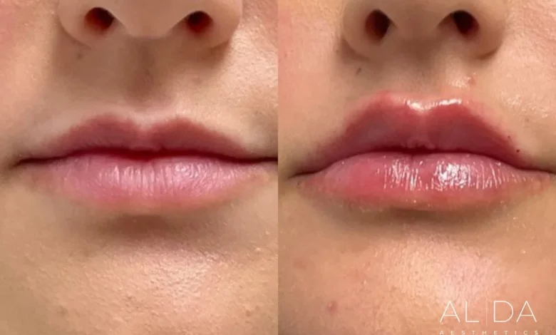 lip flip before and after