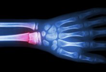 What Is the Broken Bone Theory