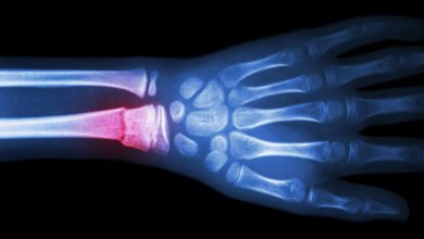 What Is the Broken Bone Theory