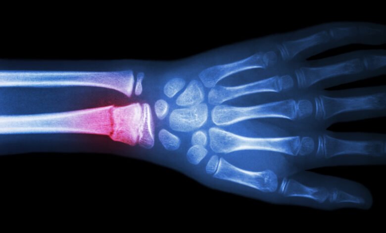 What Is the Broken Bone Theory