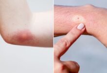 What Does a Bee Sting Look Like