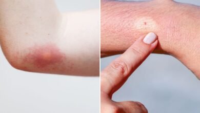 What Does a Bee Sting Look Like