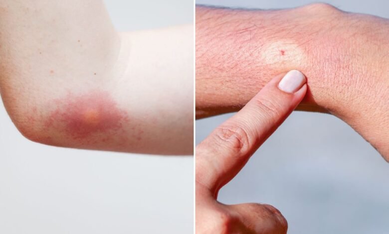What Does a Bee Sting Look Like