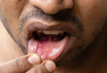 How to Get Rid of a Cold Sore in 24 Hours