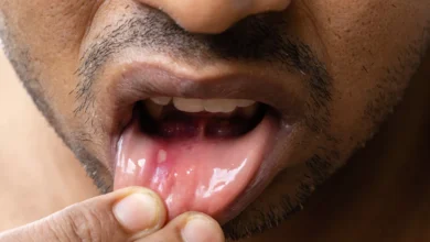 How to Get Rid of a Cold Sore in 24 Hours