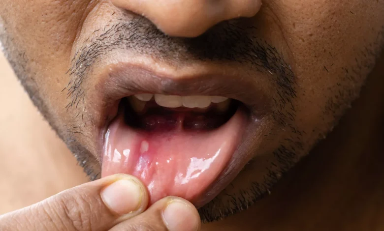 How to Get Rid of a Cold Sore in 24 Hours